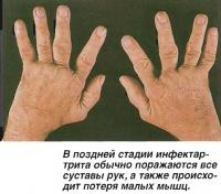 В поздней стадии инфектартрита обычно поражаются все суставы рук