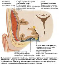 В результате давления гематомы височная доля начинает провисать