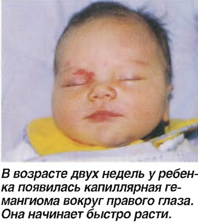 В возрасте двух недель появилась капиллярная гемангиома вокруг правого глаза