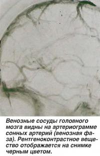 Венозные сосуды головного мозга видны на артериограмме сонных артерий