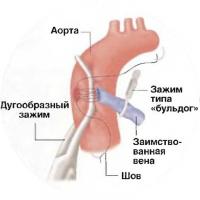 Верхний конец венозного шунта соединяется с аортой