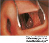 Вид полости носа при хроническом рините