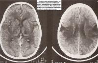 Вирусная инфекция мозга определяется в виде более темных участков