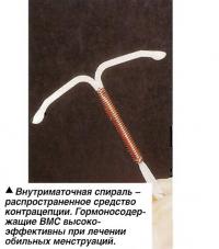 Внутриматочная спираль - распространенное средство контрацепции