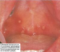 Волдыри внутри рта часто вызывают дискомфорт у больных ветряной оспой