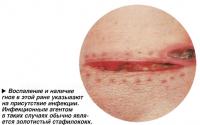Воспаление и наличие гноя в этой ране указывают на присутствие инфекции