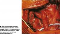 Восстановление артерии является важной частью операции