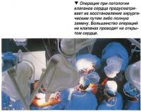 Восстановление хирургическим путем клапанов сердца либо полную замену