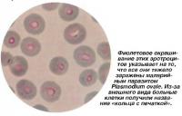 Все эритроциты тяжело заражены малярийным паразитом Plasmodium ovale