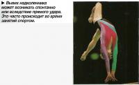Вывих надколенника может возникать спонтанно