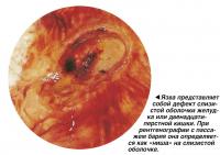 Язва представляет собой дефект слизистой оболочки желудка или кишки