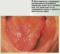 Язык пациентов может быть атрофичным
