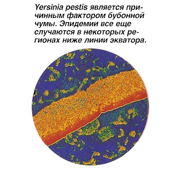 Yersinia pestis является причинным фактором бубонной чумы