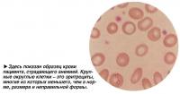 Здесь показан образец крови пациента, страдающего анемией