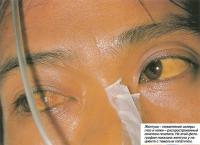 Желтуха - пожелтение склеры глаз и кожи - распространенный симптом гепатита