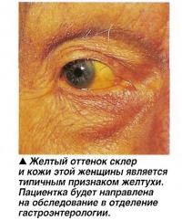 Желтый оттенок склер и кожи этой женщины является типичным признаком желтухи