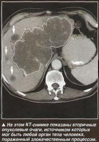 а этом КТ-снимке показаны вторичные опухолевые очаги