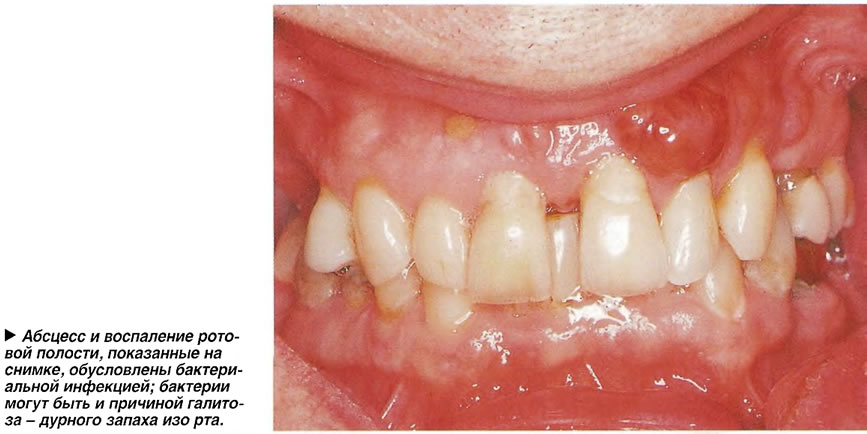 Абсцесс и воспаление ротовой полости, показанные на снимке, обусловлены бактериальной инфекцией