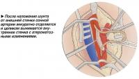 Аккуратно отделяется и целиком вынимается внутренняя стенка с атероматозными изменениями