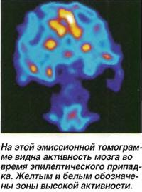 Активность мозга во время эпилептического припадка