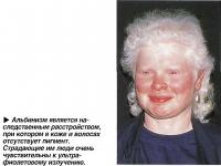 Альбинизм является наследственным расстройством, при котором в коже и волосах отсутствует пигмент