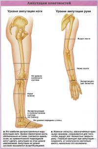 Ампутации конечностей