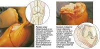 Анестезия и первый разрез