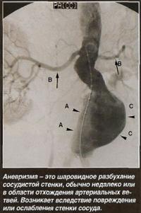 Аневризма аорты