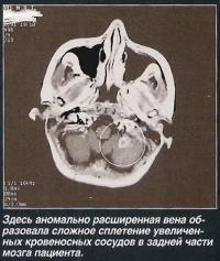 Аномально расширенная вена образовала сложное сплетение увеличенных кровеносных сосудов