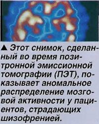 Аномальное распределение мозговой активности у пациентов, страдающих шизофренией