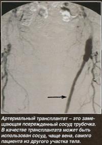 Артериальный трансплантат