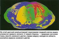 Ателектаз правого легкого