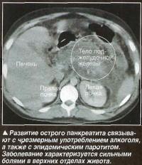 азвитие острого панкреатита связывают с чрезмерным употреблением алкоголя