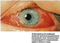 Бактериальная инфекция является причиной выраженного воспаления глаза