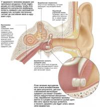 Барабанная перепонка прокалывается и в разрез вставляется ушной шунт