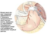Белая лента вокруг пищевода удерживается с помощью лапароскопического инструмента