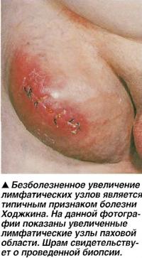 Безболезненное увеличение лимфатических узлов является признаком болезни Ходжкина