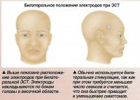 Билатеральное положение электродов при ЭСТ