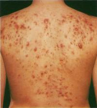 Более чем в половине случаев типичные пятна и пустулы располагаются на коже спины