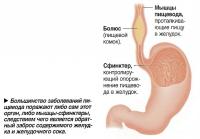 Большинство заболеваний пищевода поражают либо сам этот орган, либо мышцы-сфинктеры
