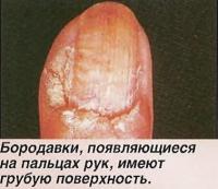 Бородавки, появляющиеся на пальцах рук, имеют грубую поверхность