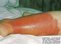 Целлюлит - это воспаление кожи и прилежащей соединительной ткани