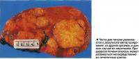 Часто рак печени развивается в результате метастазирования из других органов