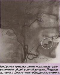 Цифровая артериограмма показывает разветвление общей сонной артерии