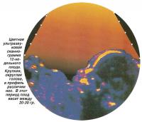 Цветная ультразвуковая сканограмма 12-недельного плода