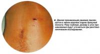 Данное проникающее ранение локализуется в левом верхнем отделе брюшной полости