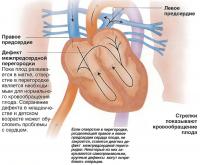 Дефект межпредсердной перегородки