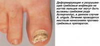 Деформирующие и разрушающие грибковые инфекции на ногтях пальцев ног
