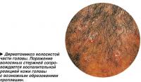 Дерматомикоз волосистой части головы