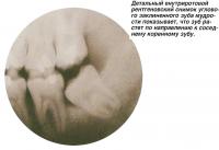 Детальный рентгеновский снимок углового заклиненного зуба мудрости